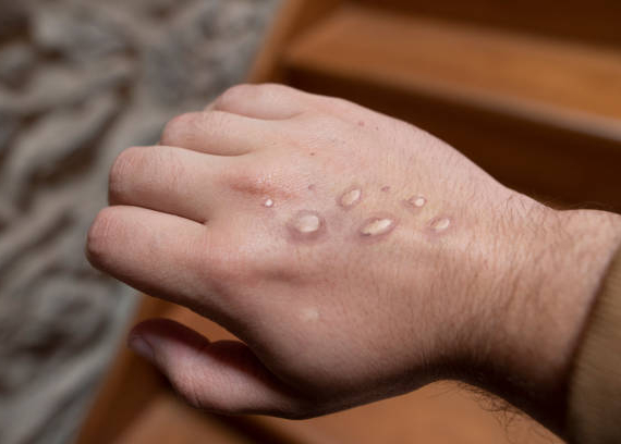 Monkey pox vesicles in a hand